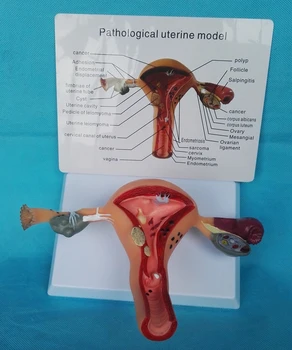 Femenina Patológica Útero Modelo de Anatomía de La Estructura de La Matriz