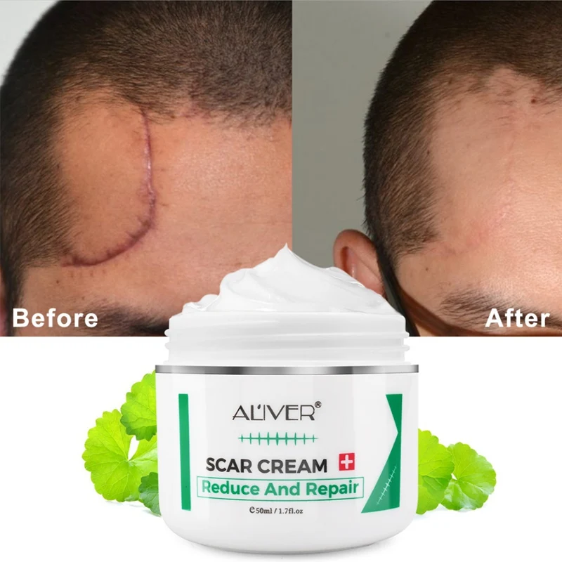 50ML Effectivel Cicatriz Eliminación Crema de Tratamiento Avanzado de la Cara y el Cuerpo las Cicatrices de los Cortes de las Marcas de Estiramiento C-Secciones Cirugías de Cuidado de la Piel 1