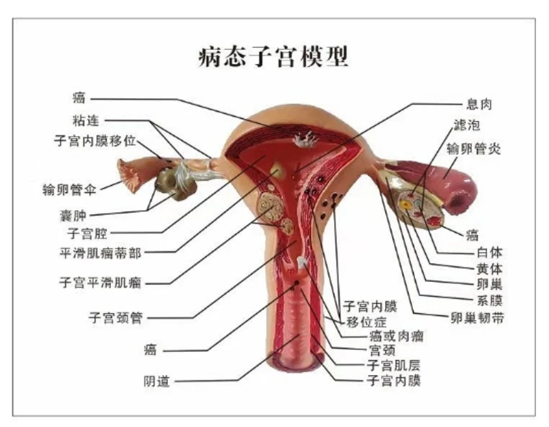 Femenina Patológica Útero Modelo de Anatomía de La Estructura de La Matriz 1