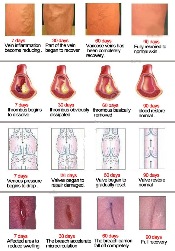 4Pcs las Venas Varicosas pomada vasculitis tratamiento de la Flebitis Granulomatous la inflamación de los vasos sanguíneos Podrido piernas Varicosas de las Venas de la Crema 1