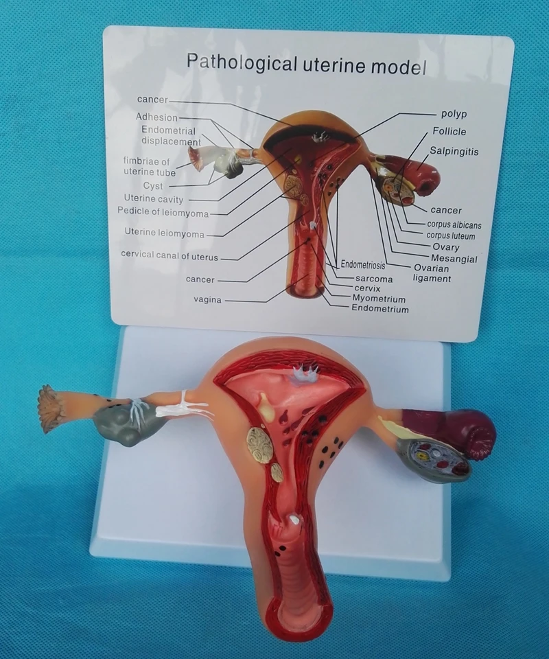Femenina Patológica Útero Modelo de Anatomía de La Estructura de La Matriz 4
