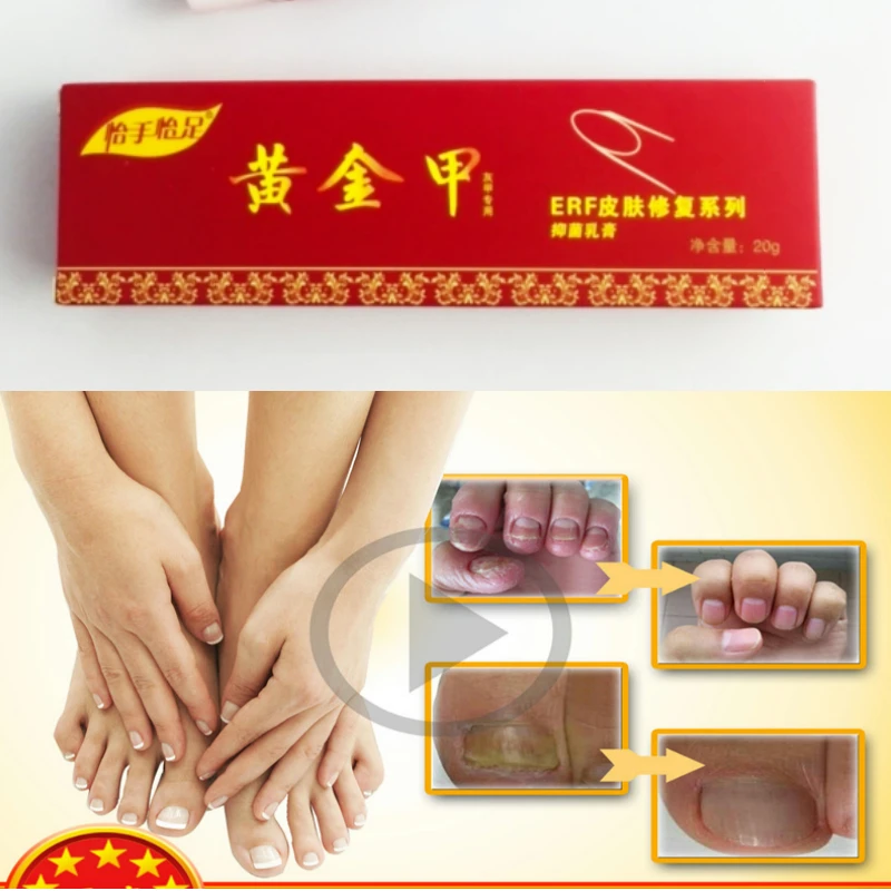 La Medicina china de Yeso de Uñas Crema de Tratamiento de la Onicomicosis Contra la Infección Micótica de la Uña Combate las Bacterias de forma Natural pomada 5
